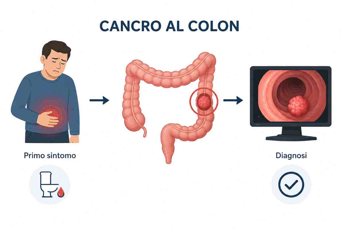 vignetta cancro al colon